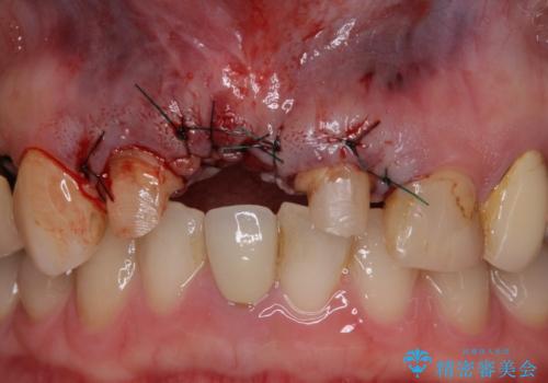 鼻の下を押すと痛い　抜歯を避けてきた歯を抜歯して自然な口元にの治療後