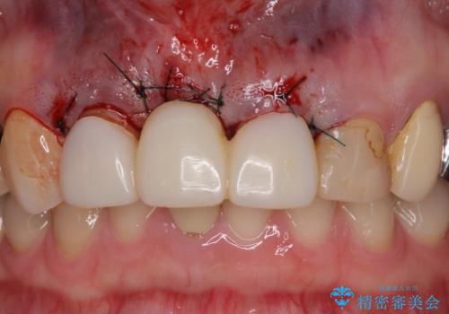 鼻の下を押すと痛い　抜歯を避けてきた歯を抜歯して自然な口元にの治療後