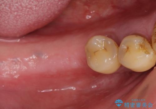 歯がぐらぐら　再生療法で抜かずに残す　50代男性の治療前