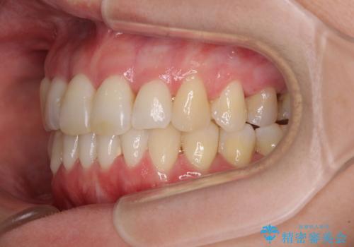 急速拡大装置で奥歯の咬み合わせを改善　インビザラインによる矯正治療の治療後