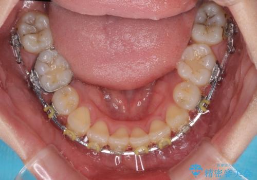 治療途中で転院　抜歯矯正の仕上げ治療の治療前