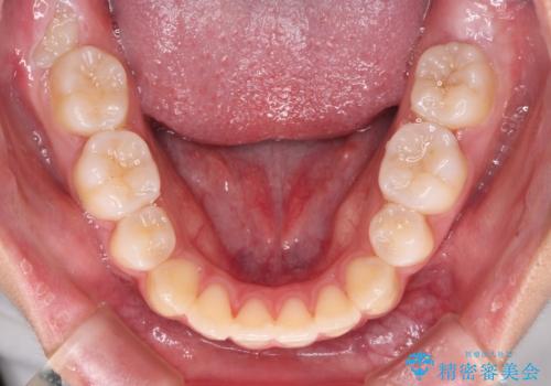 気がつくと口が開いてしまう　閉じにくい口元改善の抜歯矯正の治療後