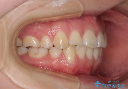前歯が磨きにくい　目立たないワイヤー装置による矯正治療の治療後