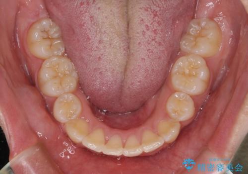 前歯が磨きにくい　目立たないワイヤー装置による矯正治療の治療後