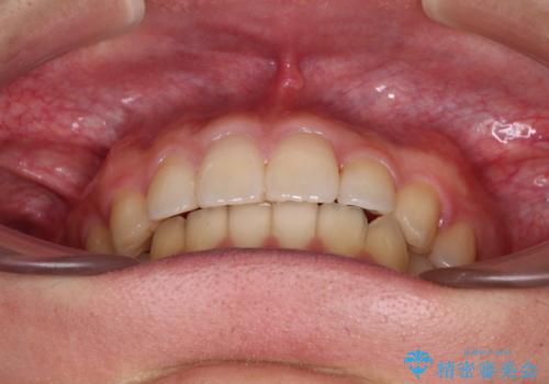 前歯のクロスバイトと抜歯が必要な奥歯の虫歯　インビザラインとインプラント治療の治療後