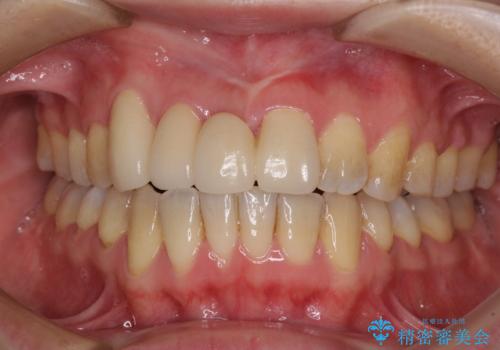転んで前歯が欠けた　折れた前歯をきっかけに矯正治療で歯列をきれいに整えるの治療後