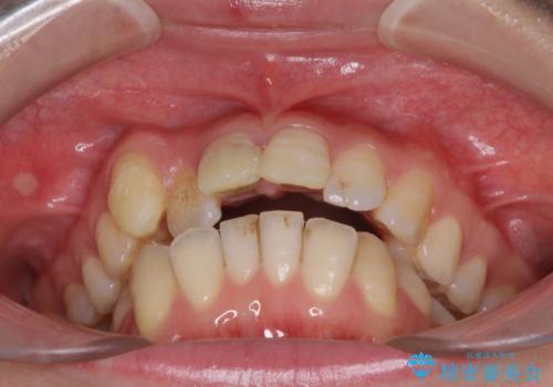 転んで前歯が欠けた　折れた前歯をきっかけに矯正治療で歯列をきれいに整えるの治療前