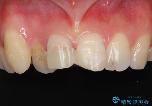 転んで前歯が欠けた　折れた前歯をきっかけに矯正治療で歯列をきれいに整えるの治療前