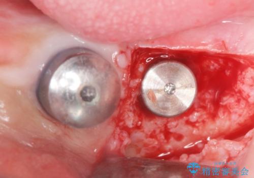 歯がぐらぐらで咬めない　奥歯のインプラント　50代男性の治療中