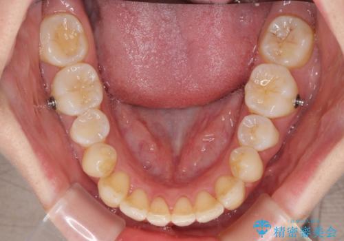 転んで前歯が欠けた　折れた前歯をきっかけに矯正治療で歯列をきれいに整えるの治療中