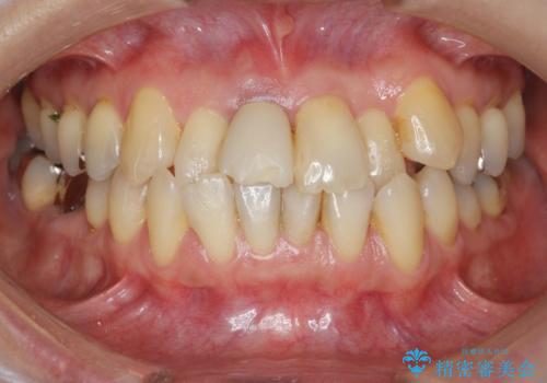 [ 矯正と補綴、総合歯科治療 ]  クロスバイトを避ける前歯部審美ブリッジの症例 治療前