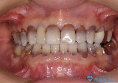 下の歯が前に出てしまう咬み合わせを治したい　インビザラインによる矯正治療の症例 治療後