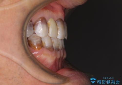 下の歯が前に出てしまう咬み合わせを治したい　インビザラインによる矯正治療の治療後