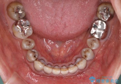 下の歯が前に出てしまう咬み合わせを治したい　インビザラインによる矯正治療の治療後