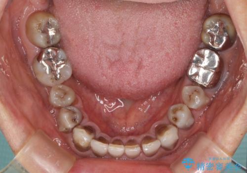 下の歯が前に出てしまう咬み合わせを治したい　インビザラインによる矯正治療の治療中