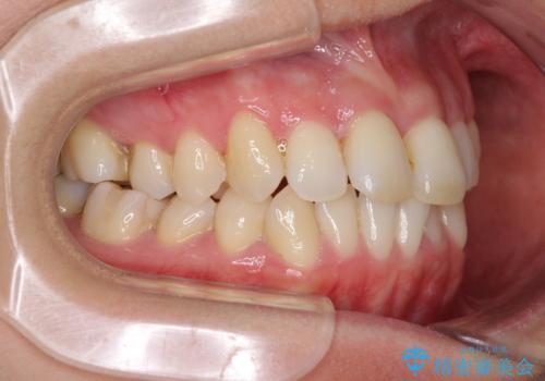 急速拡大装置で奥歯の咬み合わせを改善　インビザラインによる矯正治療の治療中