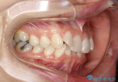 前歯のガタガタをインビザラインで矯正の治療前