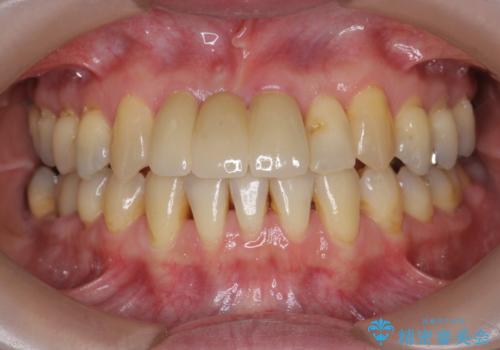 [ 矯正と補綴、総合歯科治療 ]  クロスバイトを避ける前歯部審美ブリッジの症例 治療後