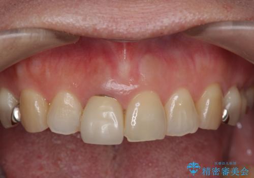 セラミッククラウン　歯ぐきの黒ずみの改善の治療前