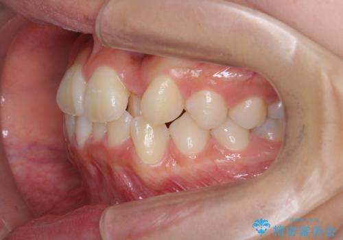 [インビザライン]  前歯のガタつき・すれ違い　マウスピース矯正治療の治療前