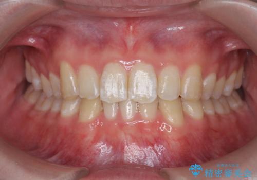 [ Three-incisor ]  歯肉退縮した歯を抜去しマウスピース治療で改善の症例 治療後