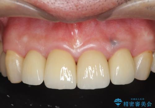 「 放置した虫歯 」 前歯セラミック治療　の治療後