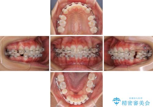 口元の突出感を改善　2年弱での抜歯矯正の治療中