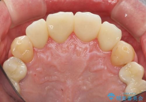「 放置した虫歯 」 前歯セラミック治療　の治療後