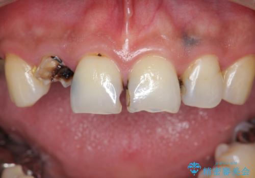 「 放置した虫歯 」 前歯セラミック治療　の治療前