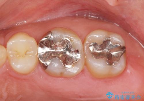 [ 矯正治療後のセラミック治療 ]  セラミックインレーで銀歯を白くの治療前