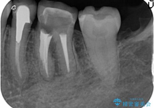 [ 歯牙破折 ]  違和感のある大臼歯 ブリッジ治療の治療前