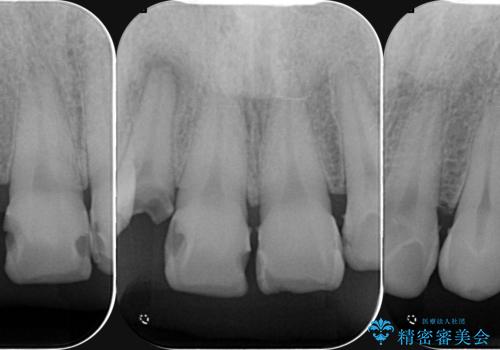 「 放置した虫歯 」 前歯セラミック治療　の治療前