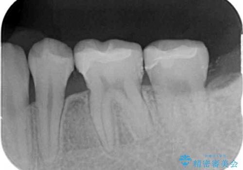 [ 矯正治療後のセラミック治療 ]  セラミックインレーで銀歯を白くの治療後