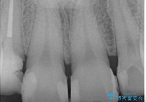 「 放置した虫歯 」 前歯セラミック治療　の治療中
