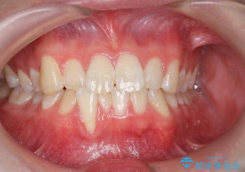 [ Three-incisor ]  歯肉退縮した歯を抜去しマウスピース治療で改善の症例 治療前