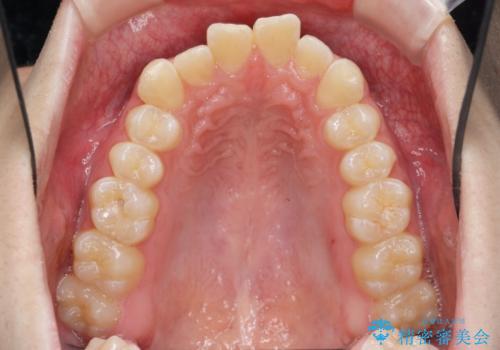 [ Three-incisor ]  歯肉退縮した歯を抜去しマウスピース治療で改善の治療前