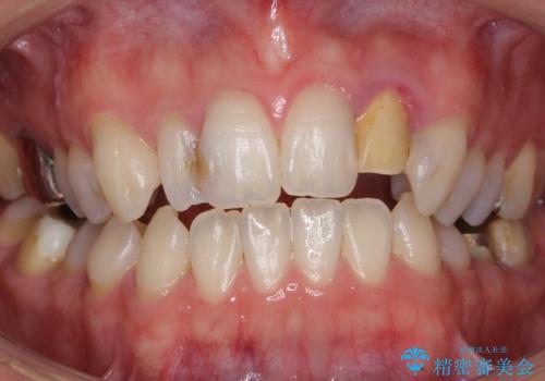 歯の外部吸収　難しい根の治療　30代男性の治療前