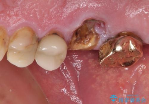 抜歯が必要な左右の奥歯　ブリッジとインプラントによる奥歯の補綴治療の治療前