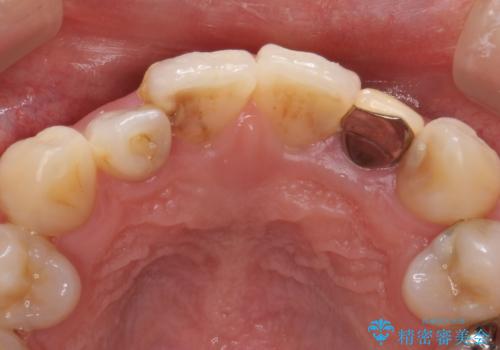 歯の外部吸収　難しい根の治療　30代男性の治療前