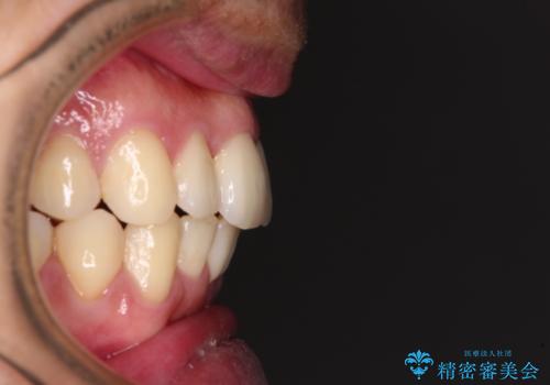 下顎骨が顕著に右側にずれている　インビザラインによる咬合改善の治療後