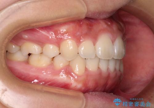 気になる八重歯を治したい　目立たないワイヤーでの抜歯矯正の治療後