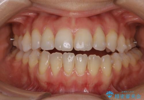 マウスピース矯正中にもPMTCで綺麗な歯を維持の治療前