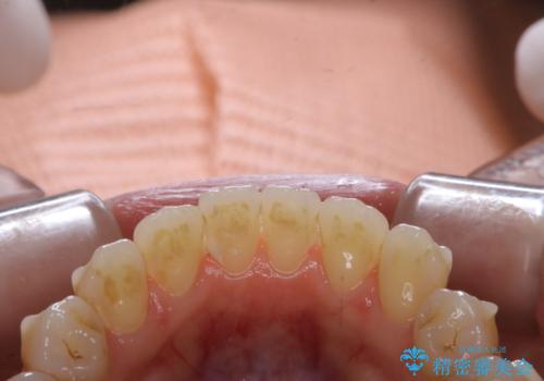 マウスピース矯正中にもPMTCで綺麗な歯を維持の治療前