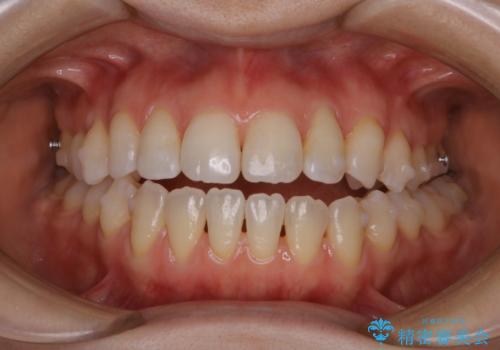 マウスピース矯正中にもPMTCで綺麗な歯を維持の治療後