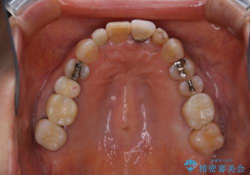大きな詰め物を被せ物に変えて、歯の破折リスクを減らすの治療後
