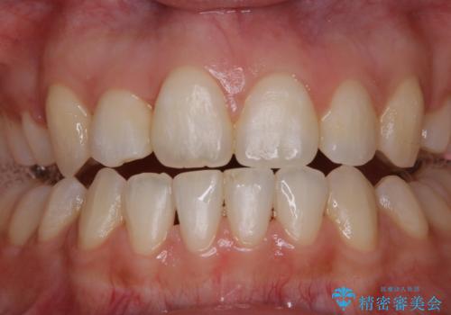 ホワイトニング　1日で真っ白な歯にの治療前
