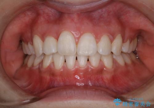 ホワイトニング　1日で真っ白な歯にの治療後