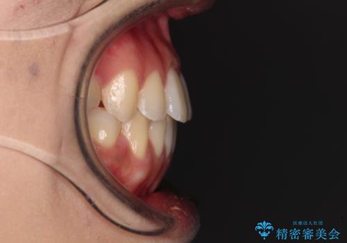上顎骨拡大を用いたインビザラインによる非抜歯矯正の治療後