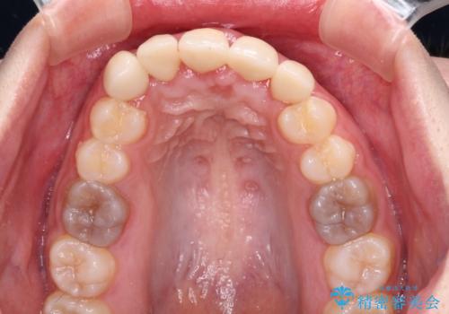 不揃いな前歯のセラミックが気になる　オールセラミッククラウンによる補綴治療の治療後