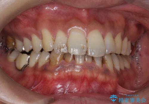 タバコによるヤニ、着色、歯の汚れをPMTC(60分コース)で除去。の治療前